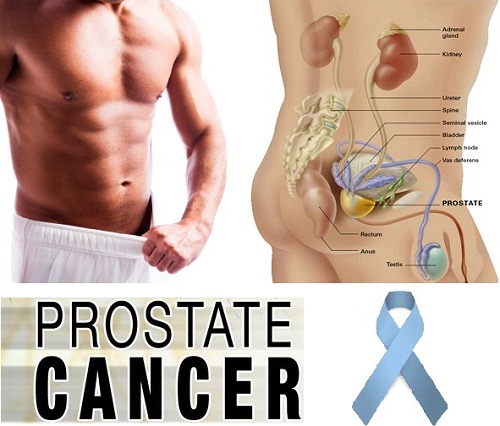 Prostate-Cancer มะเร็งต่อมลูกหมาก